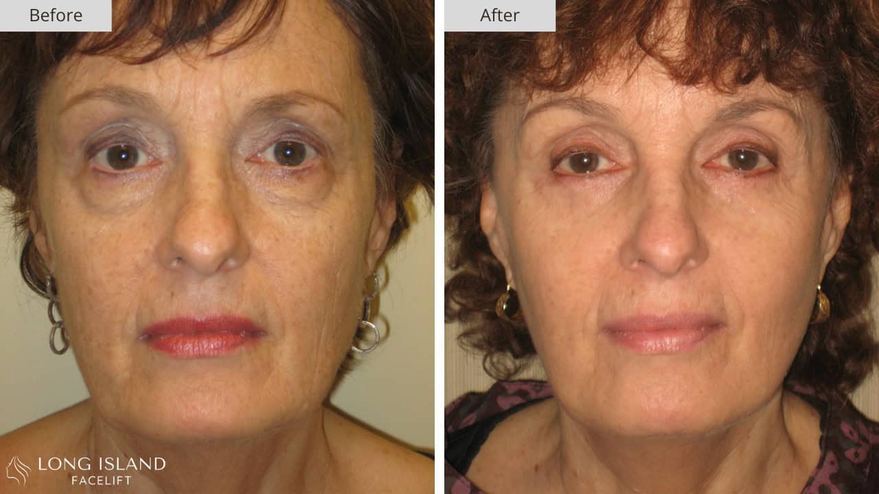 Long Island Facelift Before and After 1a