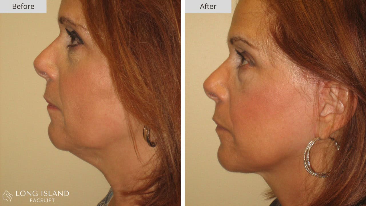 Long Island Facelift Before and After 2a
