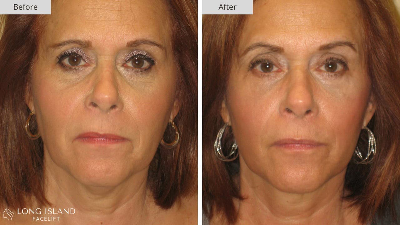 Long Island Facelift Before and After 2b