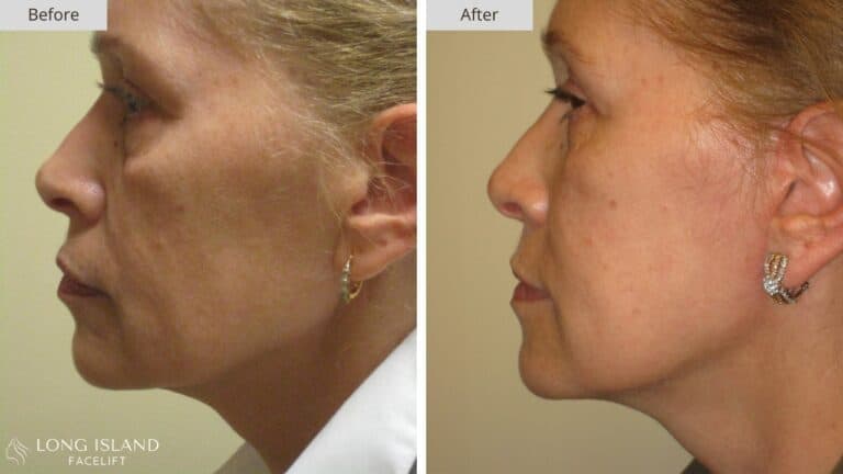 Long Island Facelift Before and After 3a