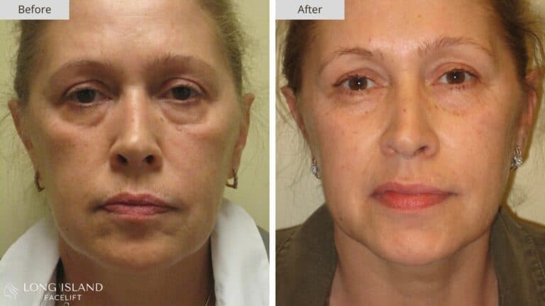 Long Island Facelift Before and After 3b
