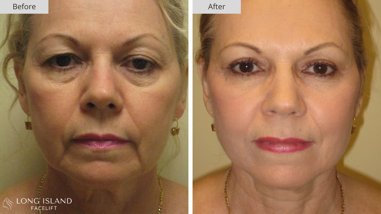 Long Island Facelift Before and After 4a