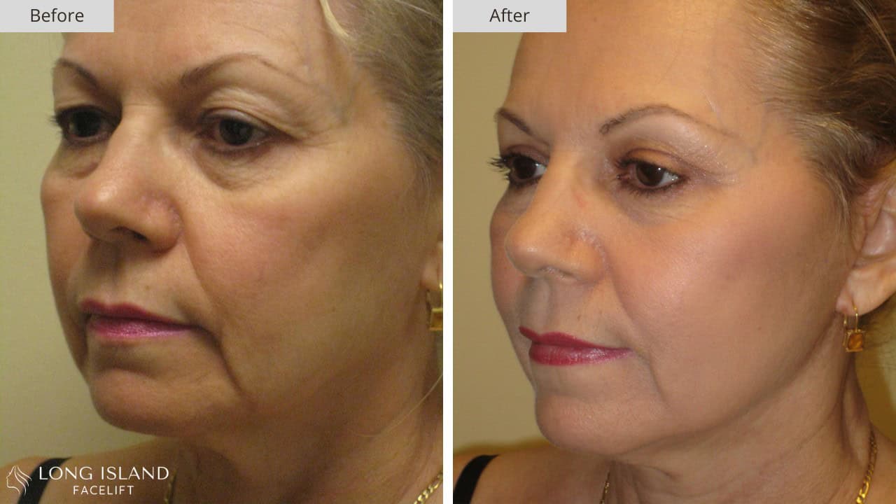 Long Island Facelift Before and After 4b