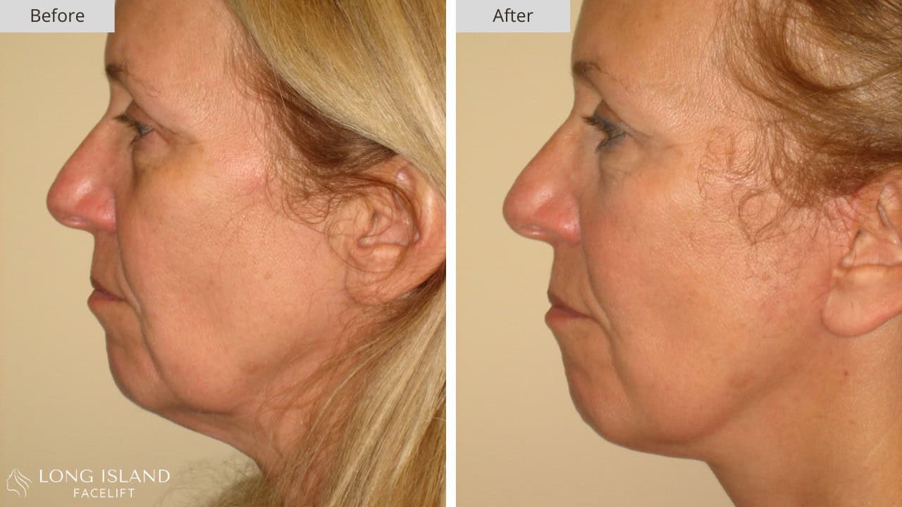 Long Island Facelift Before and After 5a