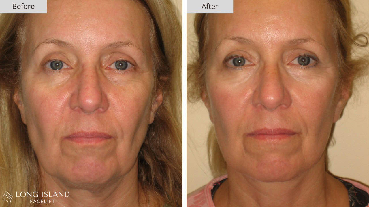 Long Island Facelift Before and After 5b