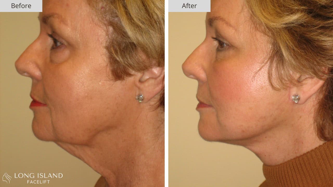 Long Island Facelift Before and After 6a