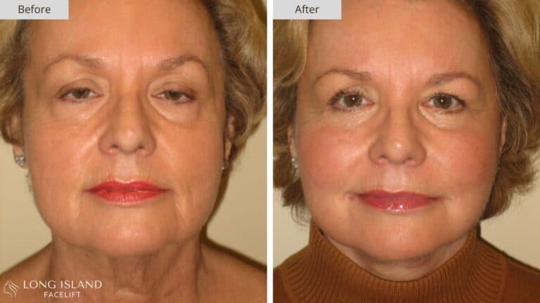Long Island Facelift Before and After 6b
