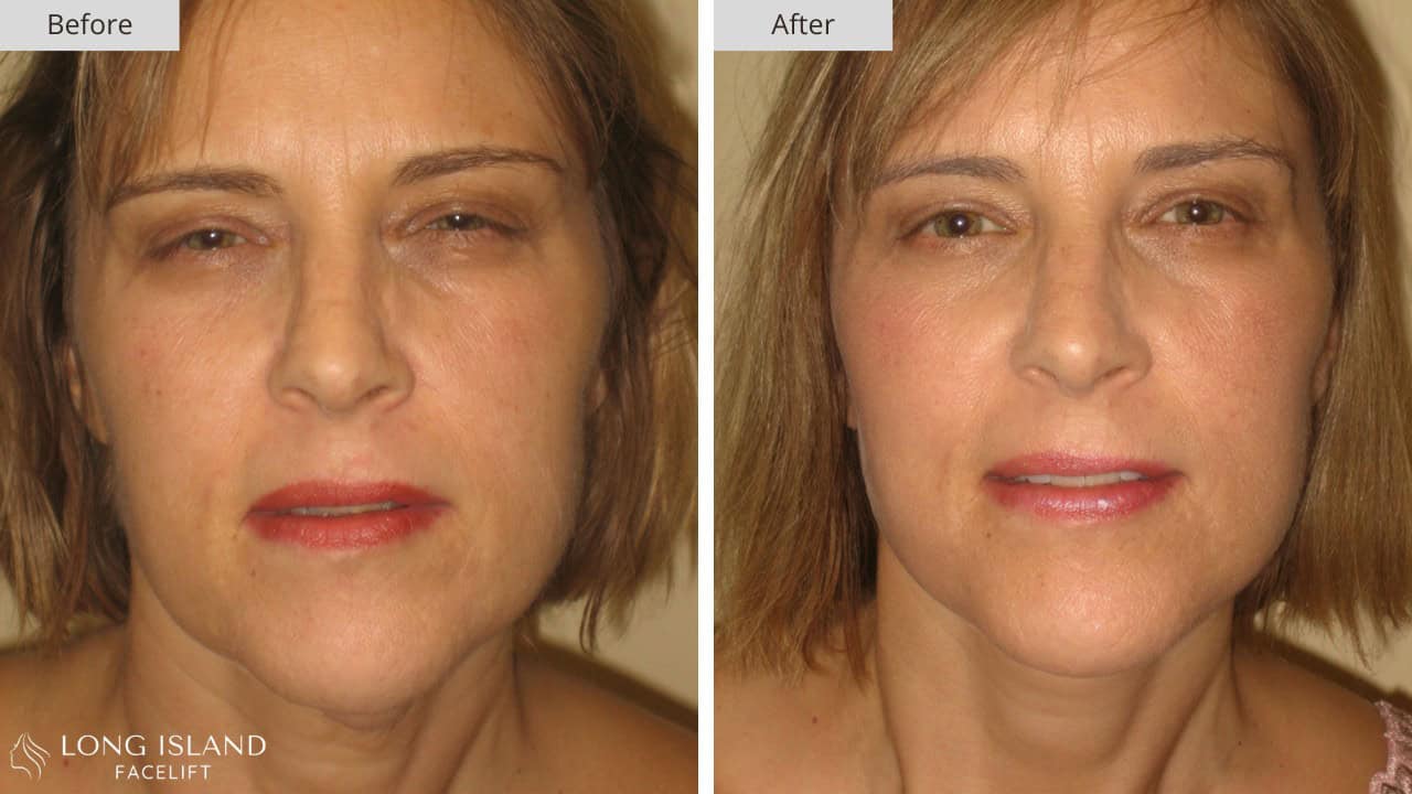 Long Island Facelift Before and After 7a