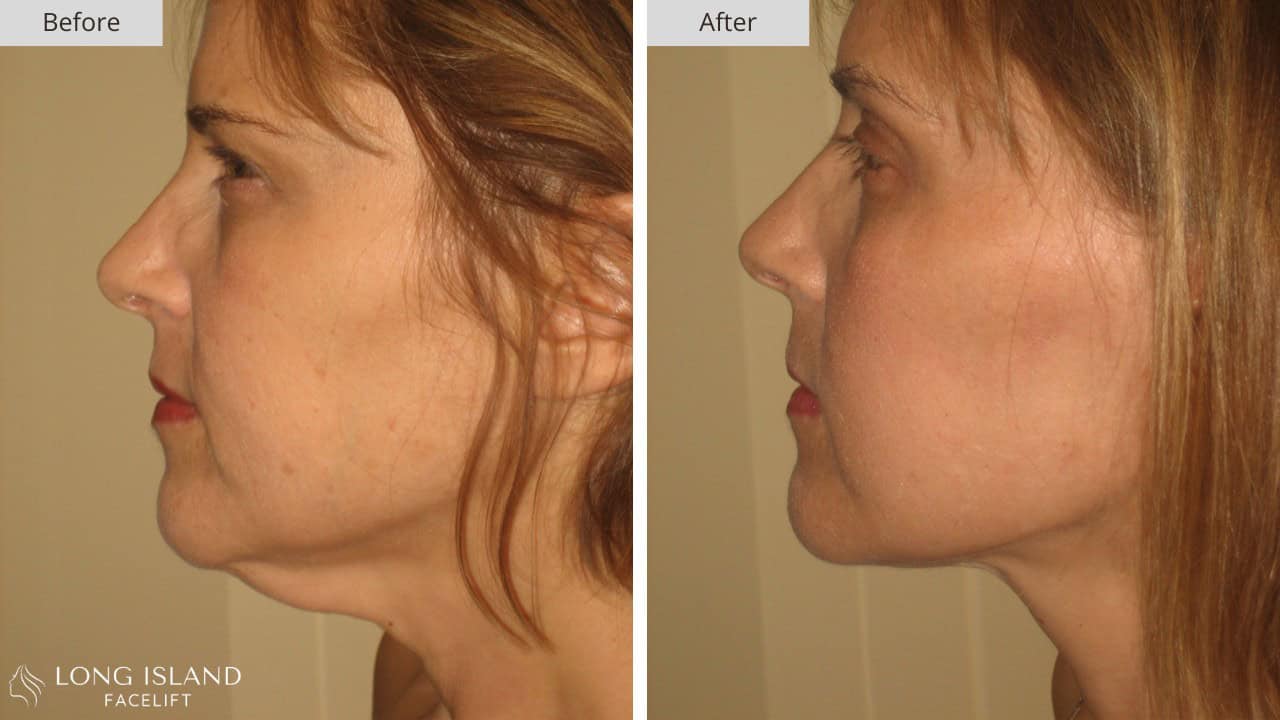 Long Island Facelift Before and After 7b