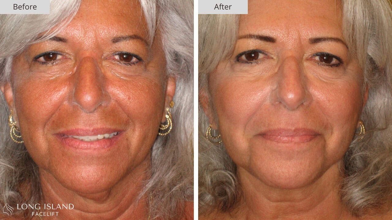 Long Island Facelift Before and After 8a