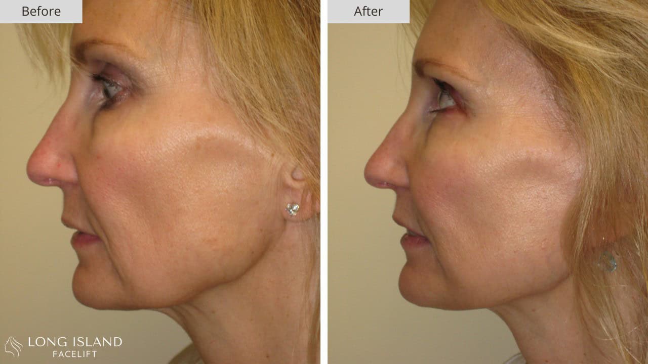 Long Island Facelift Before and After 9b