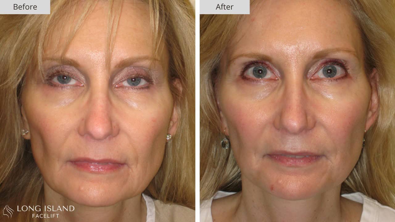 Long Island Facelift Before and After 9