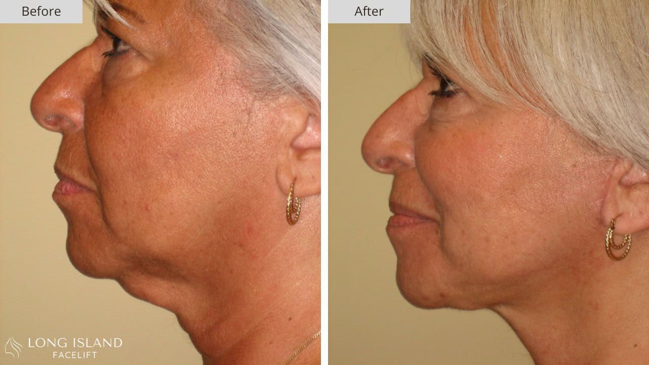 Long Island Facelift Before and After 8b