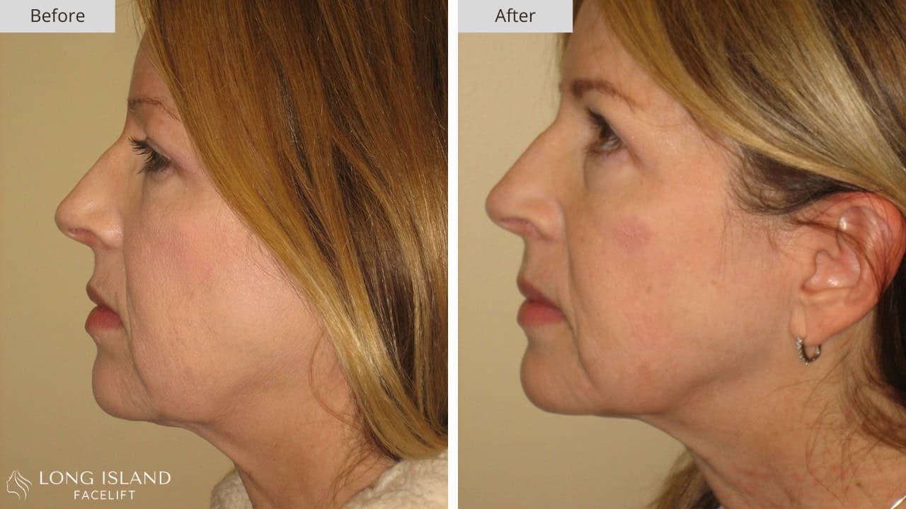 Long Island Laser Facelift Before and After 3a