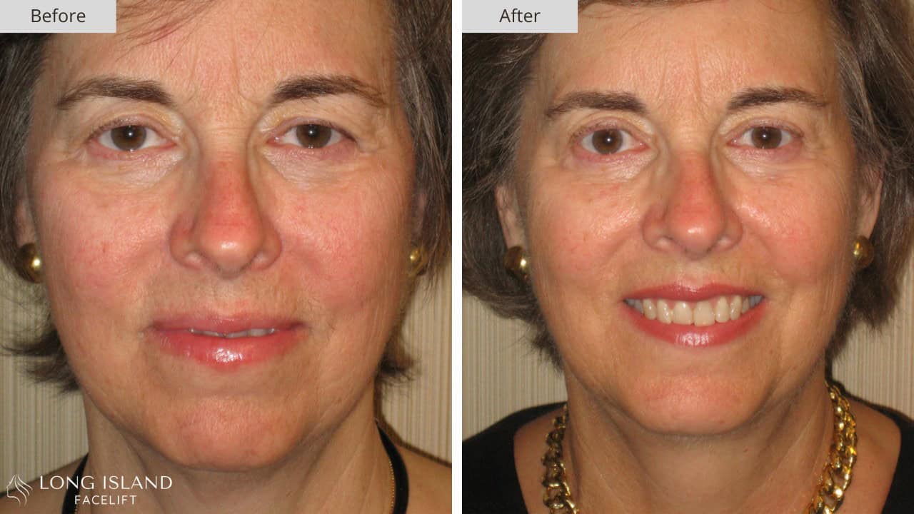 Long Island Neck Lift Before and After 2b