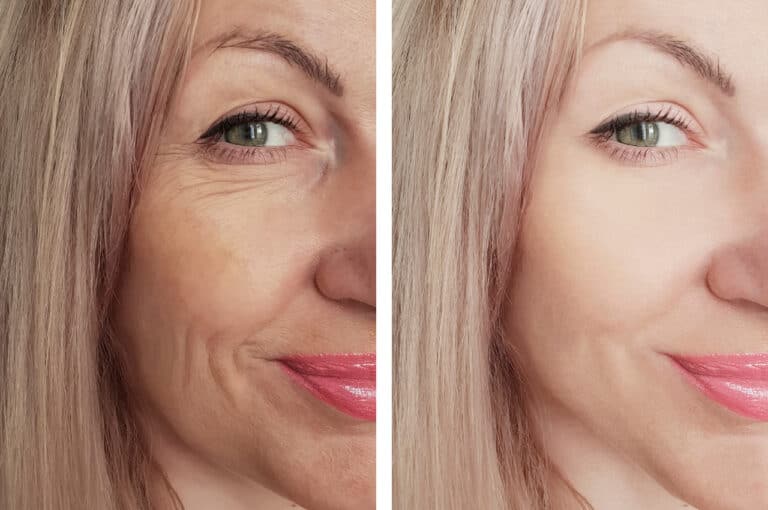 facelift procedure results